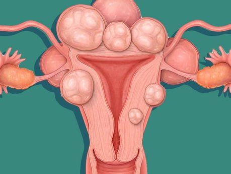 Do you have uterine fibroids? These 6 signs will tell you