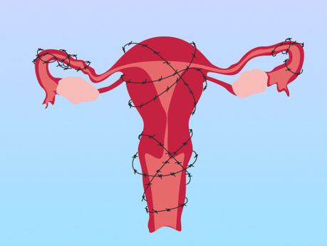 Endometriosis and IVF